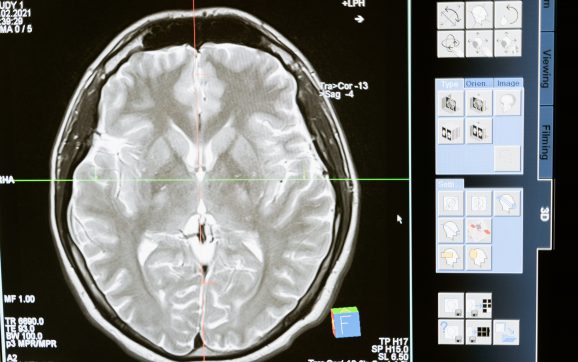 Guatemala se esfuerza en prevenir la Parálisis cerebral desde el embarazo