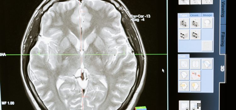 Guatemala se esfuerza en prevenir la Parálisis cerebral desde el embarazo