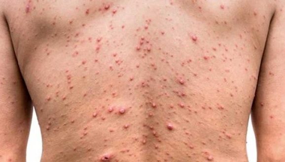 61 casos de viruela símica se registran en Guatemala