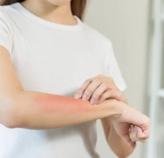 Cuídate del sarampión, toma estas precauciones