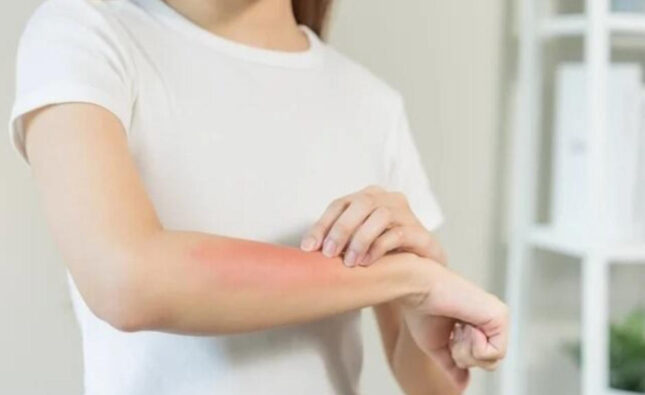 Cuídate del sarampión, toma estas precauciones