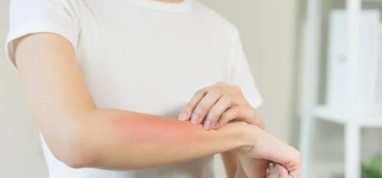 Cuídate del sarampión, toma estas precauciones