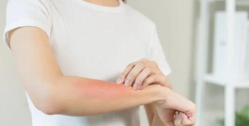 Cuídate del sarampión, toma estas precauciones