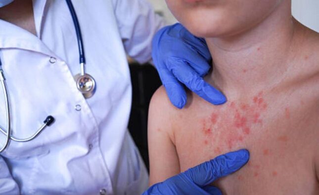 Salud confirma el fallecimiento de dos bebés por sarampión