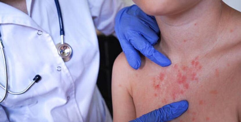 Salud confirma el fallecimiento de dos bebés por sarampión